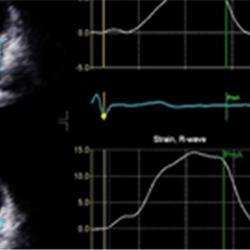 BSE advanced imaging: Imaging in atrial fibrillation
